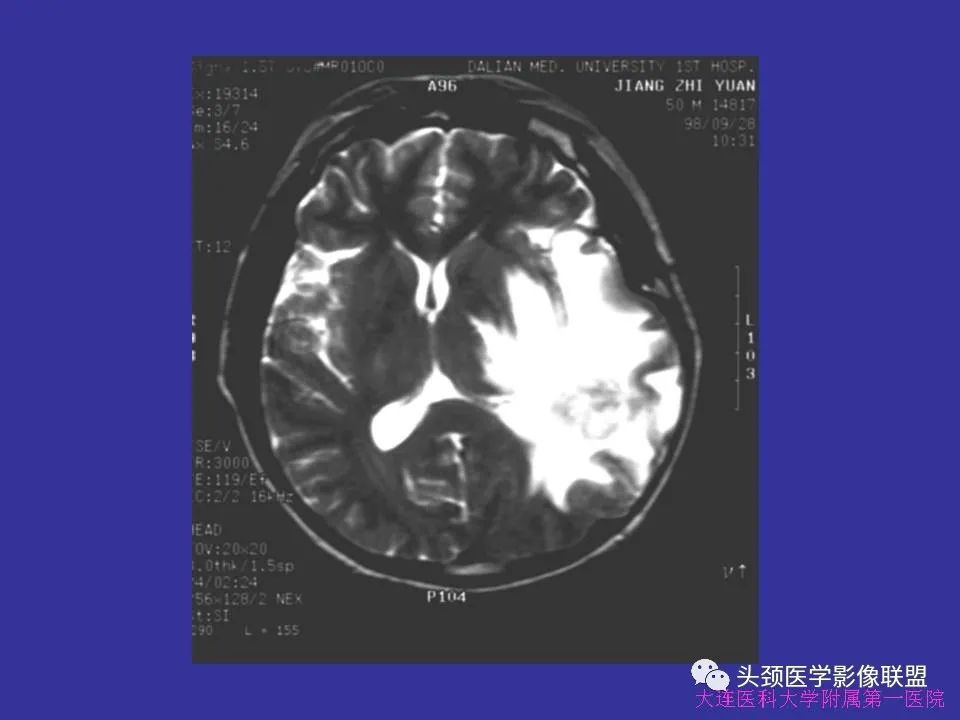 影像PPT - 【PPT】胶质瘤影像诊断及鉴别诊断-53