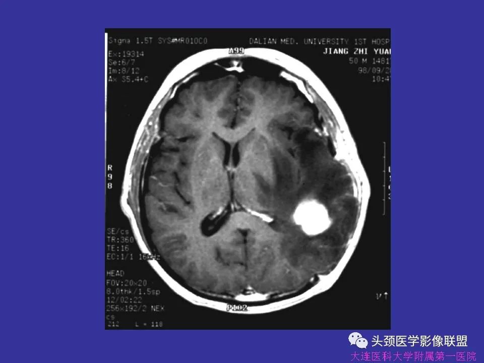 影像PPT - 【PPT】胶质瘤影像诊断及鉴别诊断-54