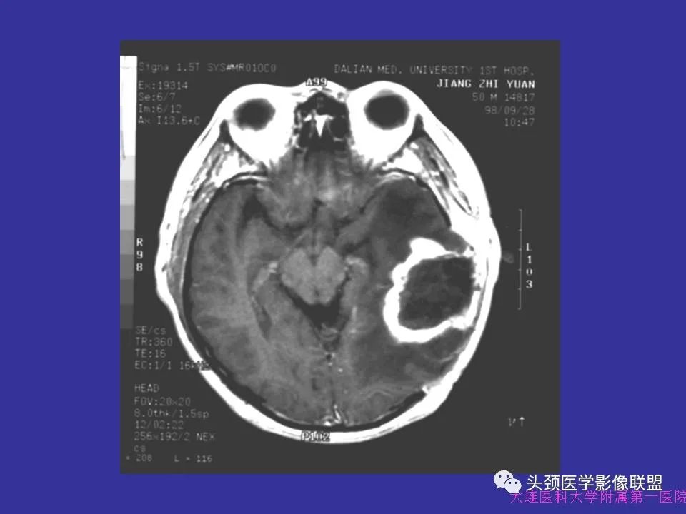 影像PPT - 【PPT】胶质瘤影像诊断及鉴别诊断-55