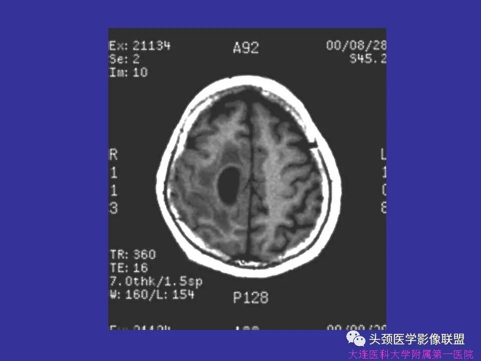 影像PPT - 【PPT】胶质瘤影像诊断及鉴别诊断-56