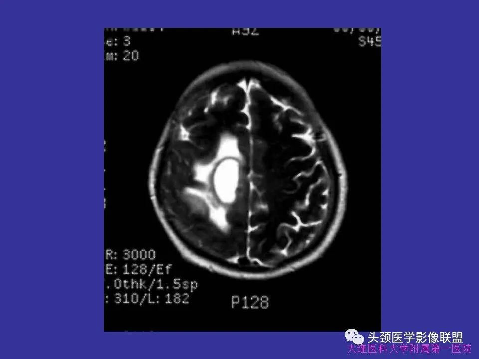 影像PPT - 【PPT】胶质瘤影像诊断及鉴别诊断-57