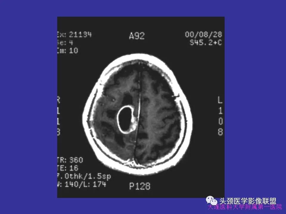 影像PPT - 【PPT】胶质瘤影像诊断及鉴别诊断-58