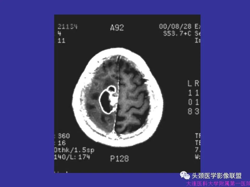影像PPT - 【PPT】胶质瘤影像诊断及鉴别诊断-59