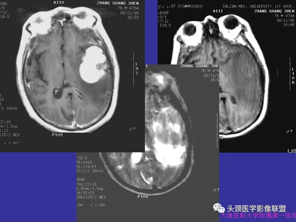 影像PPT - 【PPT】胶质瘤影像诊断及鉴别诊断-60