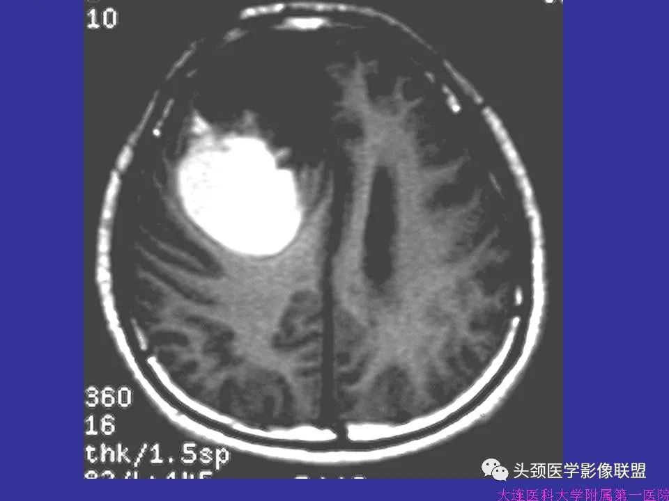 影像PPT - 【PPT】胶质瘤影像诊断及鉴别诊断-61