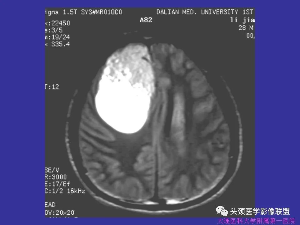 影像PPT - 【PPT】胶质瘤影像诊断及鉴别诊断-62