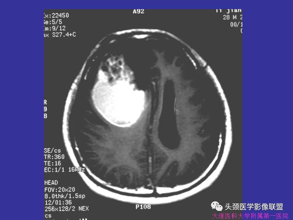 影像PPT - 【PPT】胶质瘤影像诊断及鉴别诊断-63