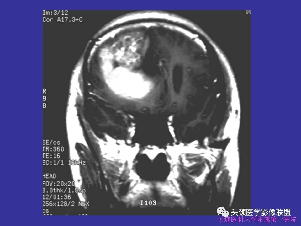 影像PPT - 【PPT】胶质瘤影像诊断及鉴别诊断-64