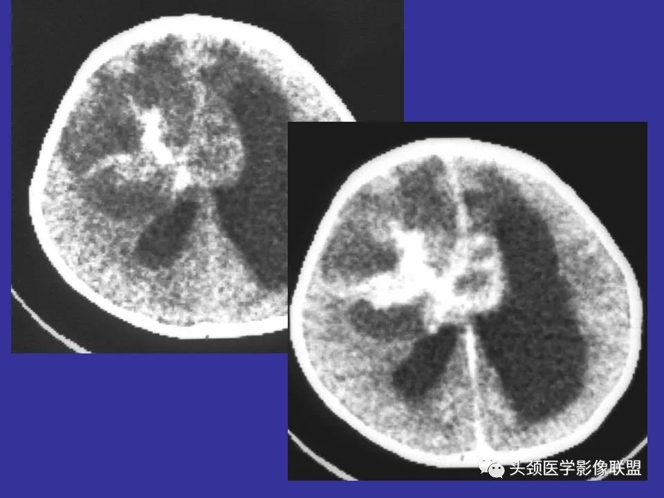 影像PPT - 【PPT】胶质瘤影像诊断及鉴别诊断-68