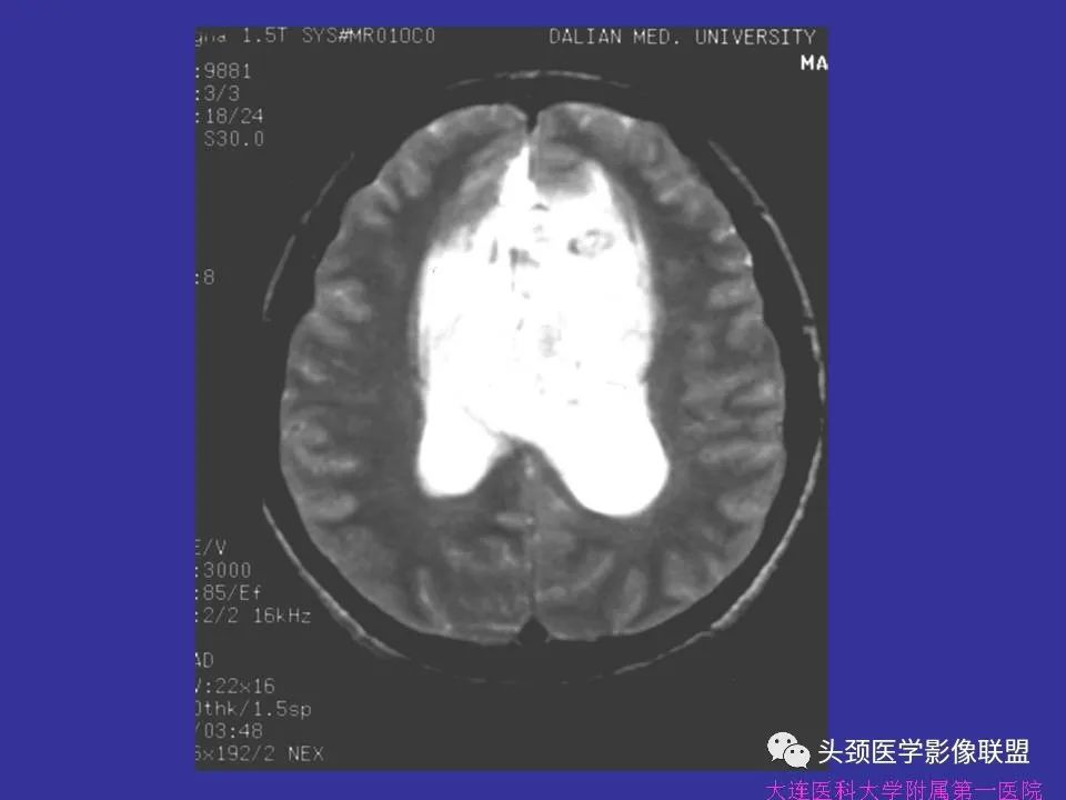 影像PPT - 【PPT】胶质瘤影像诊断及鉴别诊断-70