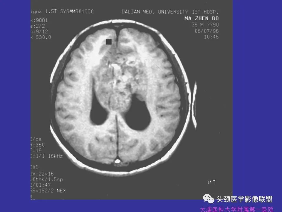 影像PPT - 【PPT】胶质瘤影像诊断及鉴别诊断-69