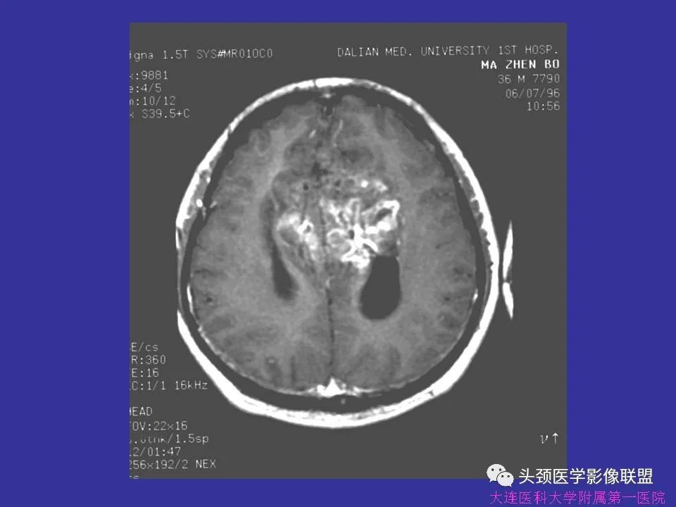 影像PPT - 【PPT】胶质瘤影像诊断及鉴别诊断-71