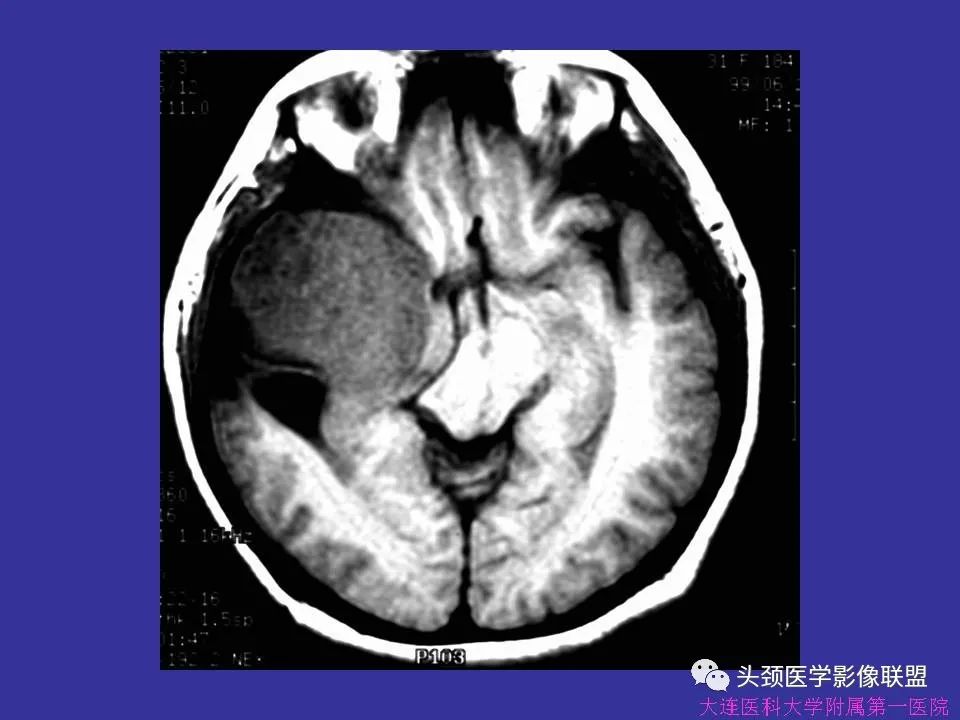 影像PPT - 【PPT】胶质瘤影像诊断及鉴别诊断-76