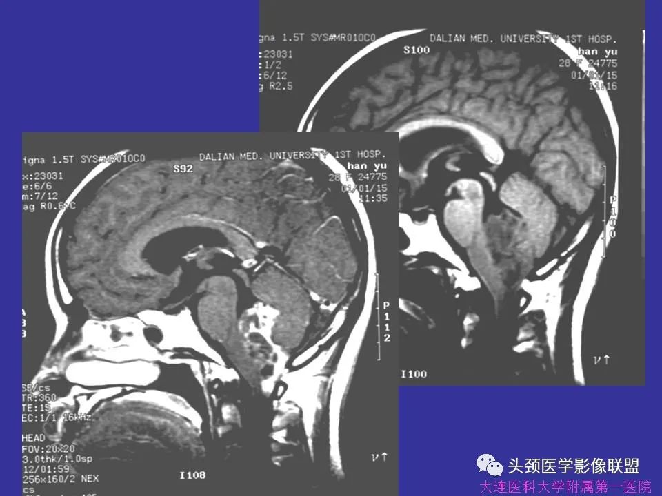 影像PPT - 【PPT】胶质瘤影像诊断及鉴别诊断-75