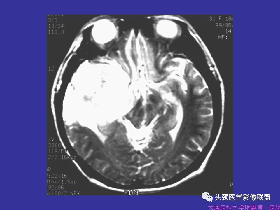影像PPT - 【PPT】胶质瘤影像诊断及鉴别诊断-77