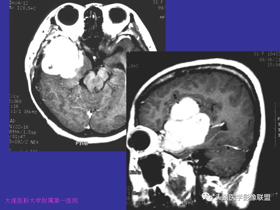 影像PPT - 【PPT】胶质瘤影像诊断及鉴别诊断-78