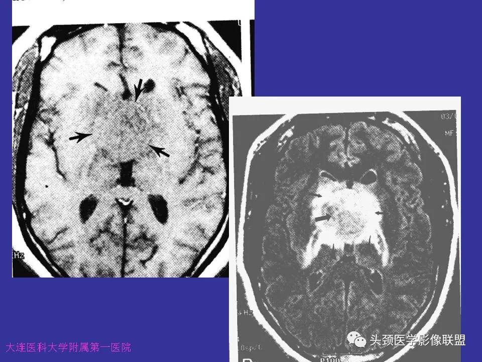 影像PPT - 【PPT】胶质瘤影像诊断及鉴别诊断-81