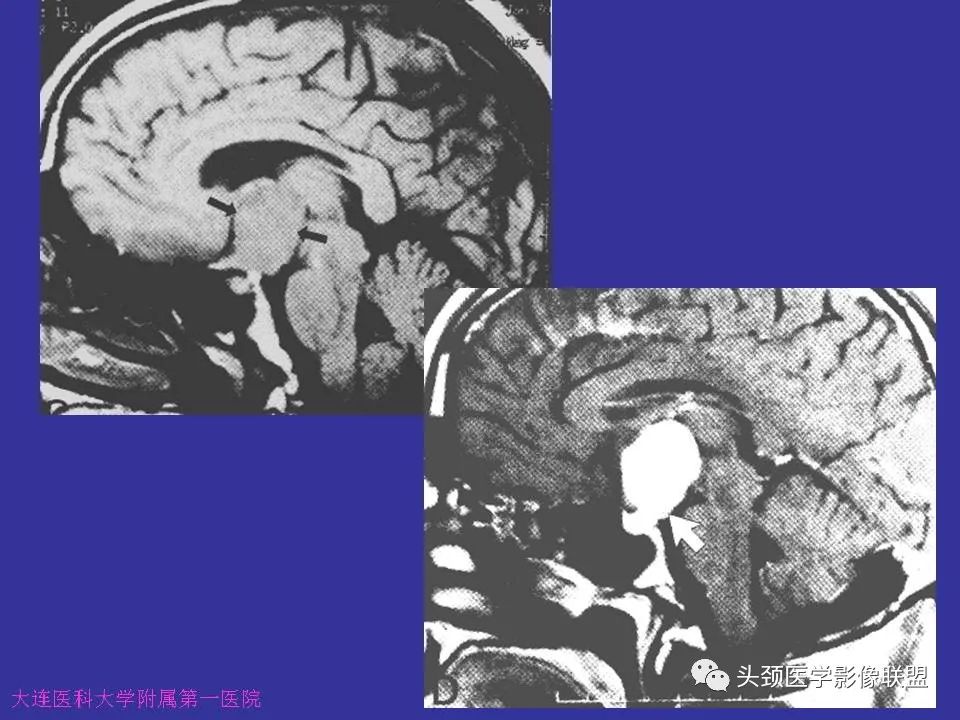 影像PPT - 【PPT】胶质瘤影像诊断及鉴别诊断-82