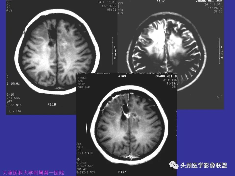 影像PPT - 【PPT】胶质瘤影像诊断及鉴别诊断-85