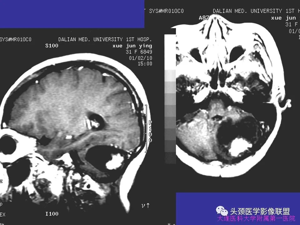 影像PPT - 【PPT】胶质瘤影像诊断及鉴别诊断-87
