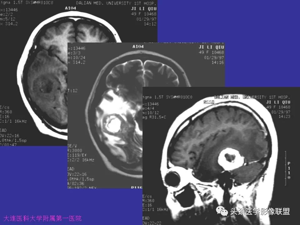 影像PPT - 【PPT】胶质瘤影像诊断及鉴别诊断-90
