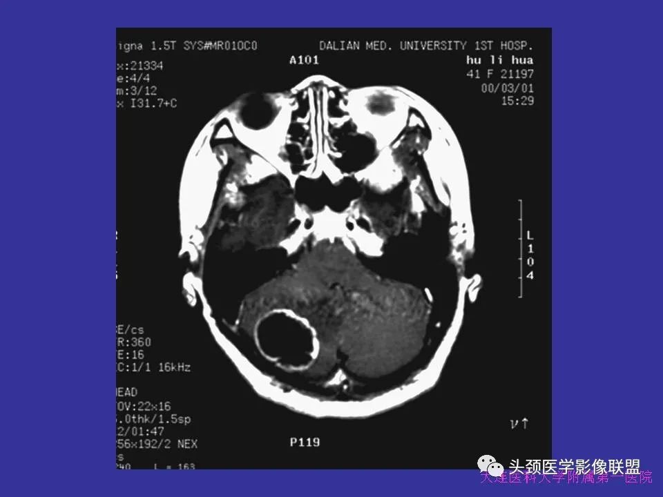 影像PPT - 【PPT】胶质瘤影像诊断及鉴别诊断-91