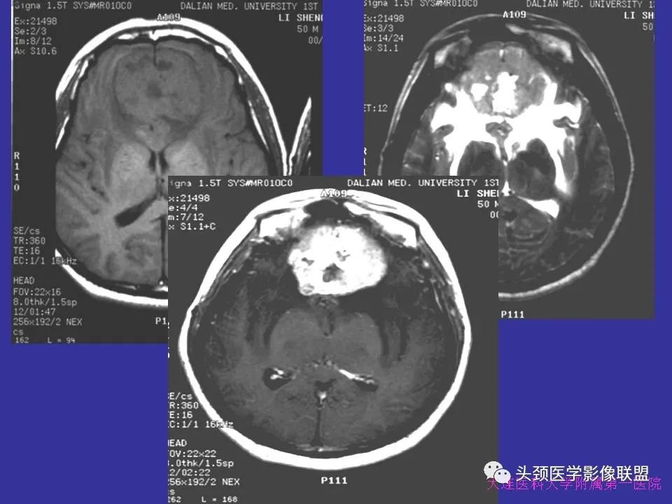 影像PPT - 【PPT】胶质瘤影像诊断及鉴别诊断-94