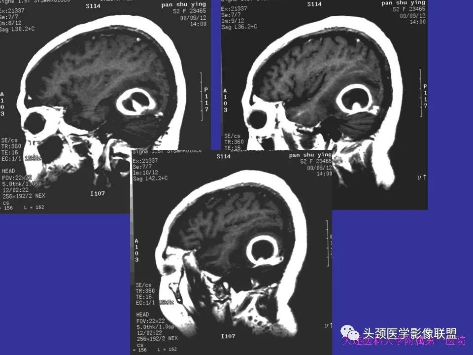 影像PPT - 【PPT】胶质瘤影像诊断及鉴别诊断-97