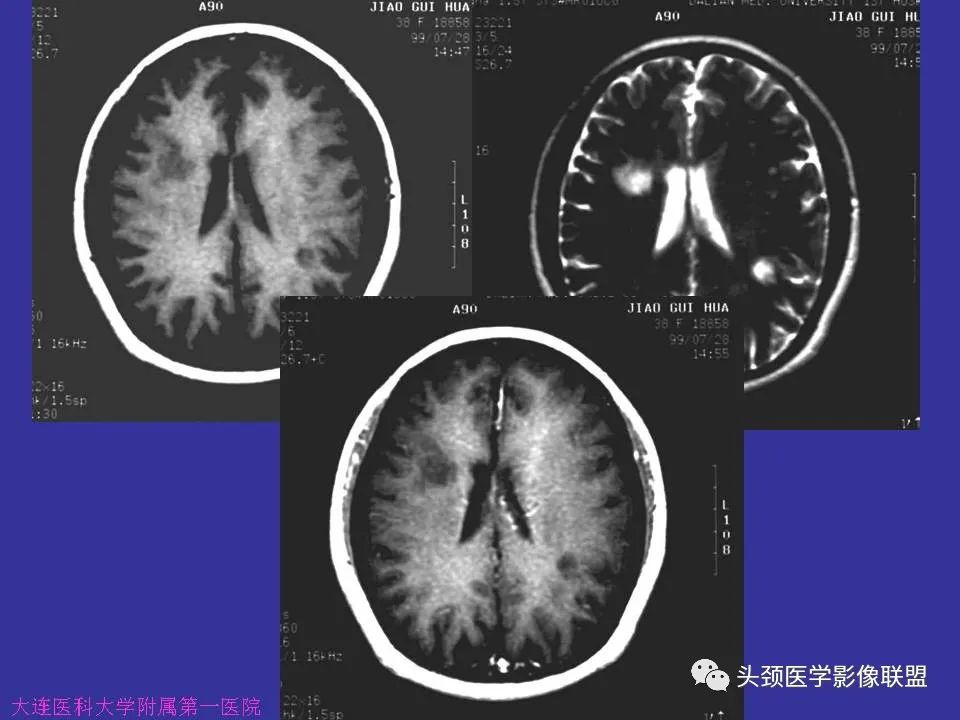 影像PPT - 【PPT】胶质瘤影像诊断及鉴别诊断-99