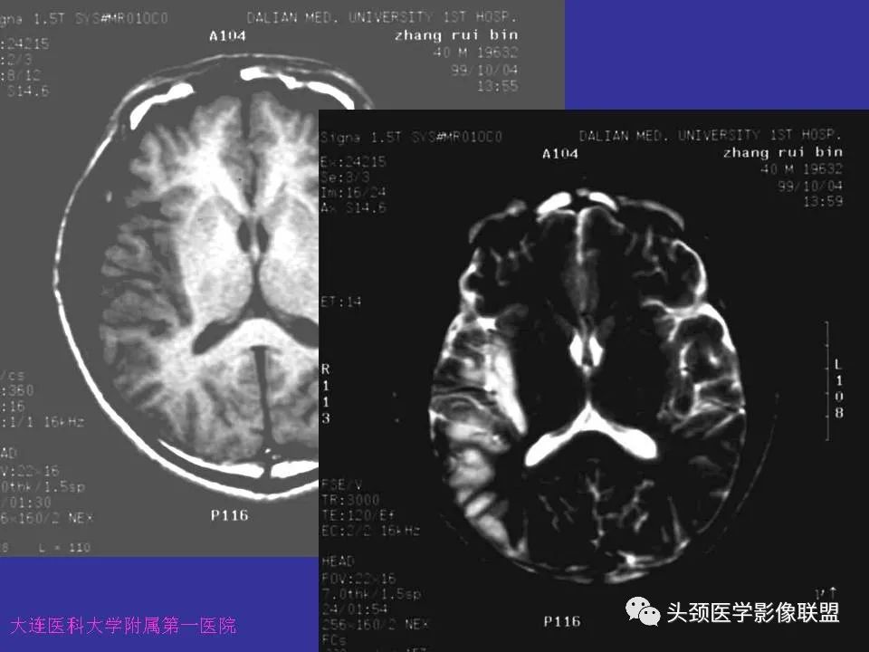影像PPT - 【PPT】胶质瘤影像诊断及鉴别诊断-100