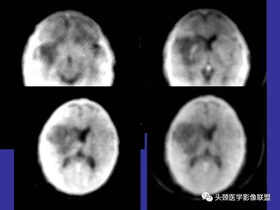 影像PPT - 【PPT】胶质瘤影像诊断及鉴别诊断-101