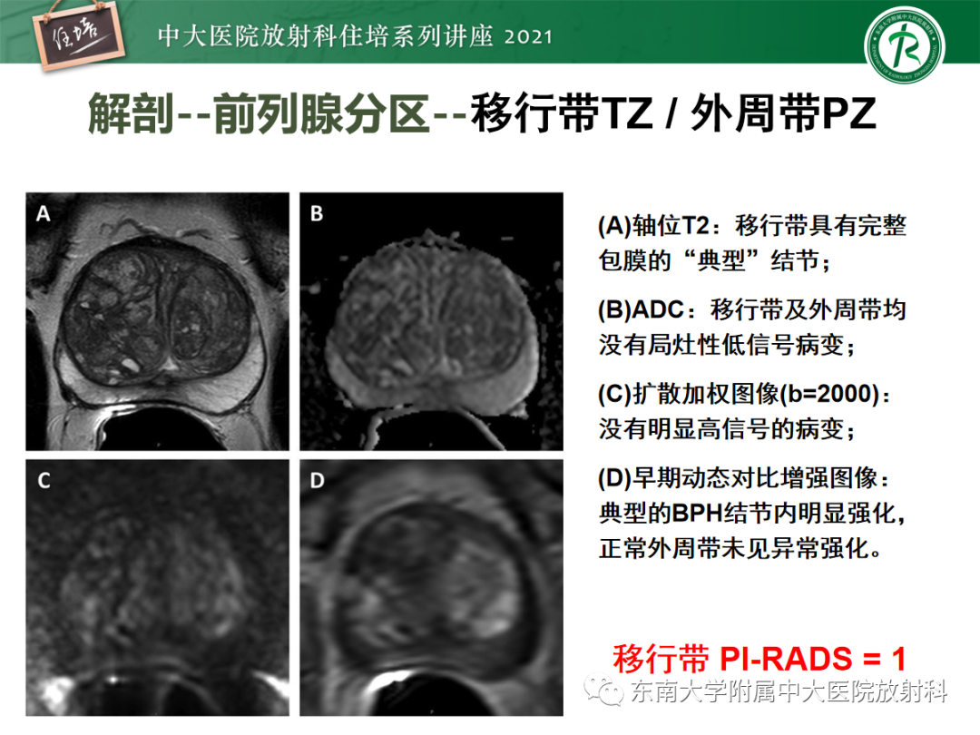 影像PPT - 【PPT】前列腺PI-RADS v2.1要点解读及临床应用-14