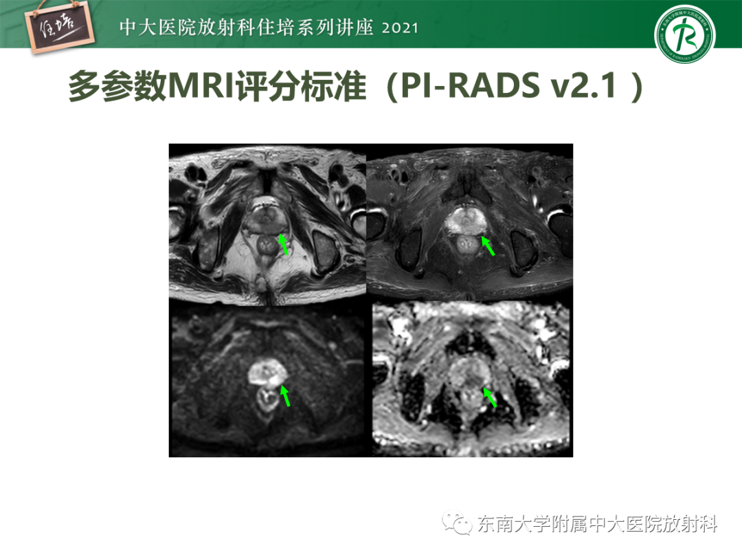 影像PPT - 【PPT】前列腺PI-RADS v2.1要点解读及临床应用-16