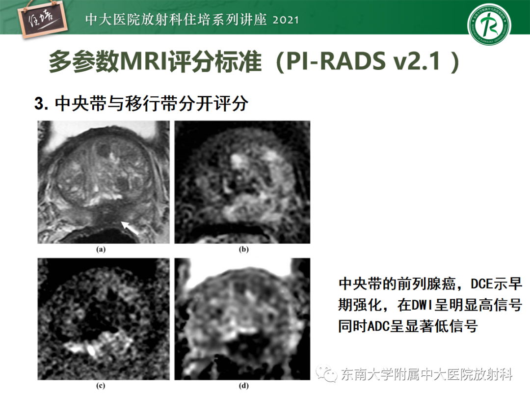 影像PPT - 【PPT】前列腺PI-RADS v2.1要点解读及临床应用-22