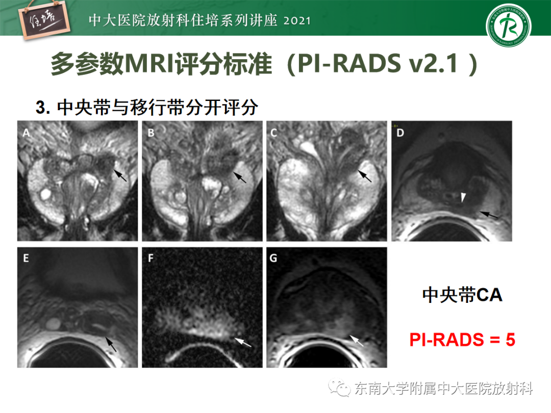 影像PPT - 【PPT】前列腺PI-RADS v2.1要点解读及临床应用-23