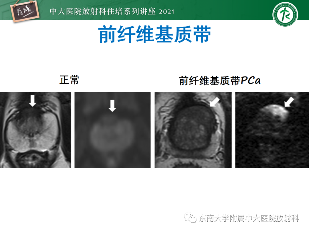 影像PPT - 【PPT】前列腺PI-RADS v2.1要点解读及临床应用-25