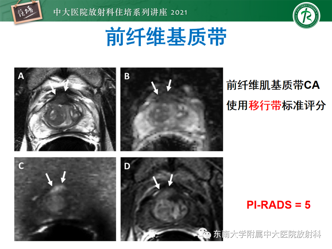 影像PPT - 【PPT】前列腺PI-RADS v2.1要点解读及临床应用-26