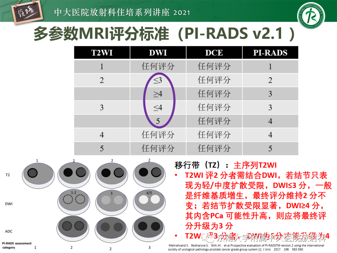 影像PPT - 【PPT】前列腺PI-RADS v2.1要点解读及临床应用-30