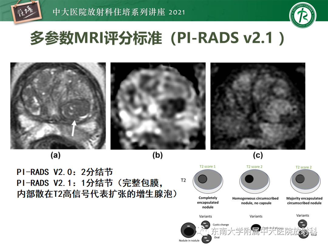 影像PPT - 【PPT】前列腺PI-RADS v2.1要点解读及临床应用-32