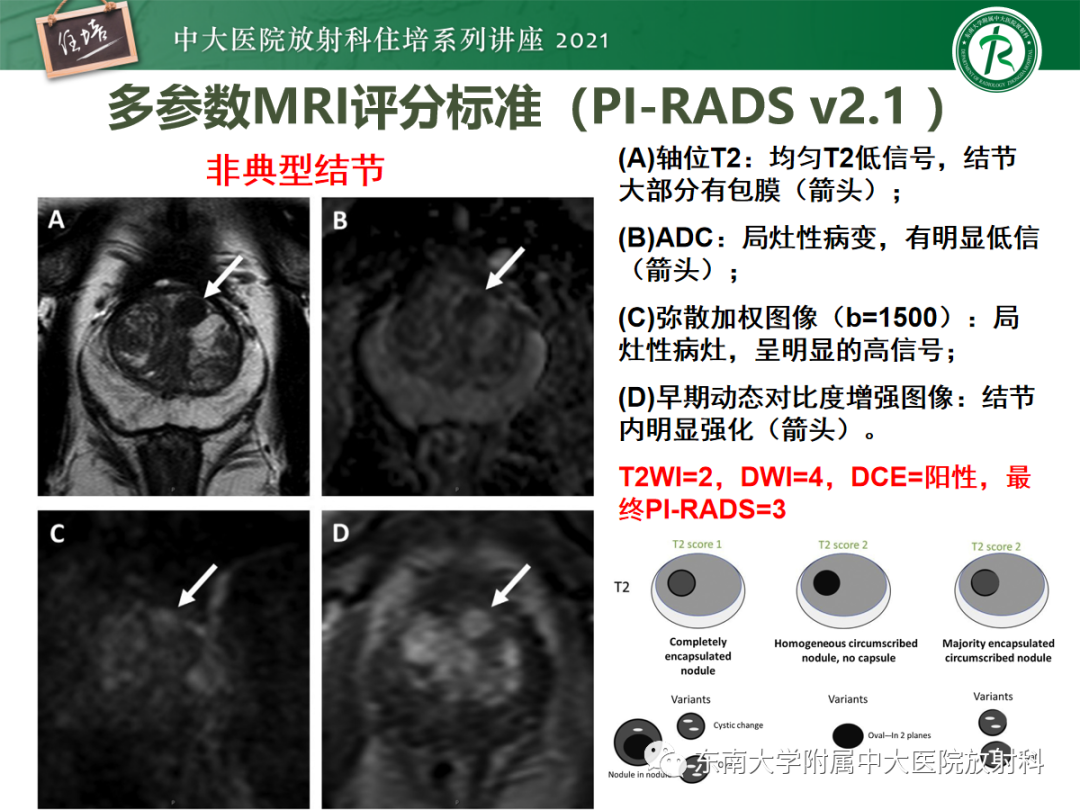 影像PPT - 【PPT】前列腺PI-RADS v2.1要点解读及临床应用-33