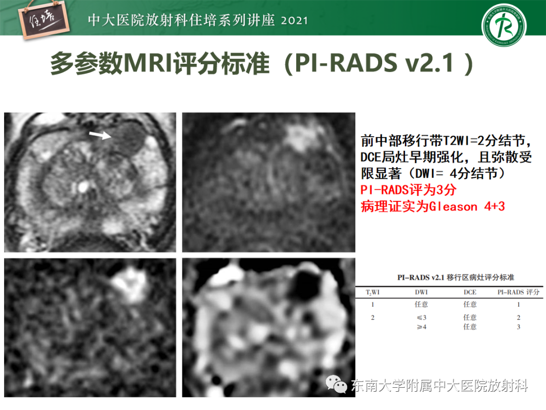 影像PPT - 【PPT】前列腺PI-RADS v2.1要点解读及临床应用-34