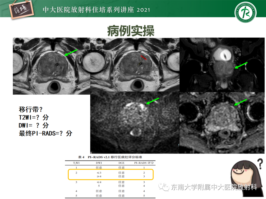 影像PPT - 【PPT】前列腺PI-RADS v2.1要点解读及临床应用-35