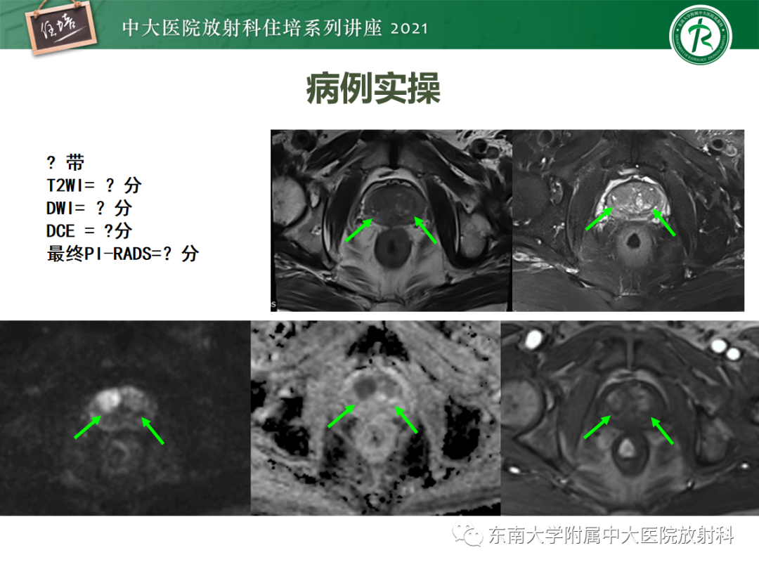 影像PPT - 【PPT】前列腺PI-RADS v2.1要点解读及临床应用-36