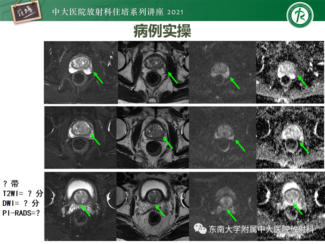 影像PPT - 【PPT】前列腺PI-RADS v2.1要点解读及临床应用-40