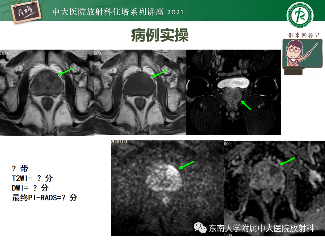 影像PPT - 【PPT】前列腺PI-RADS v2.1要点解读及临床应用-39