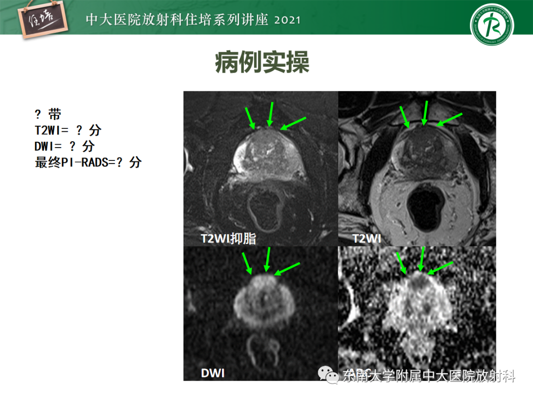 影像PPT - 【PPT】前列腺PI-RADS v2.1要点解读及临床应用-37