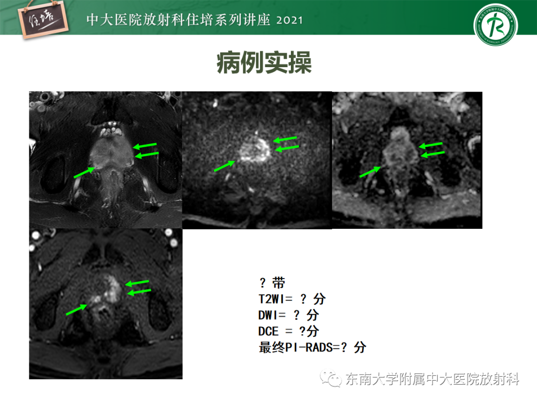 影像PPT - 【PPT】前列腺PI-RADS v2.1要点解读及临床应用-42