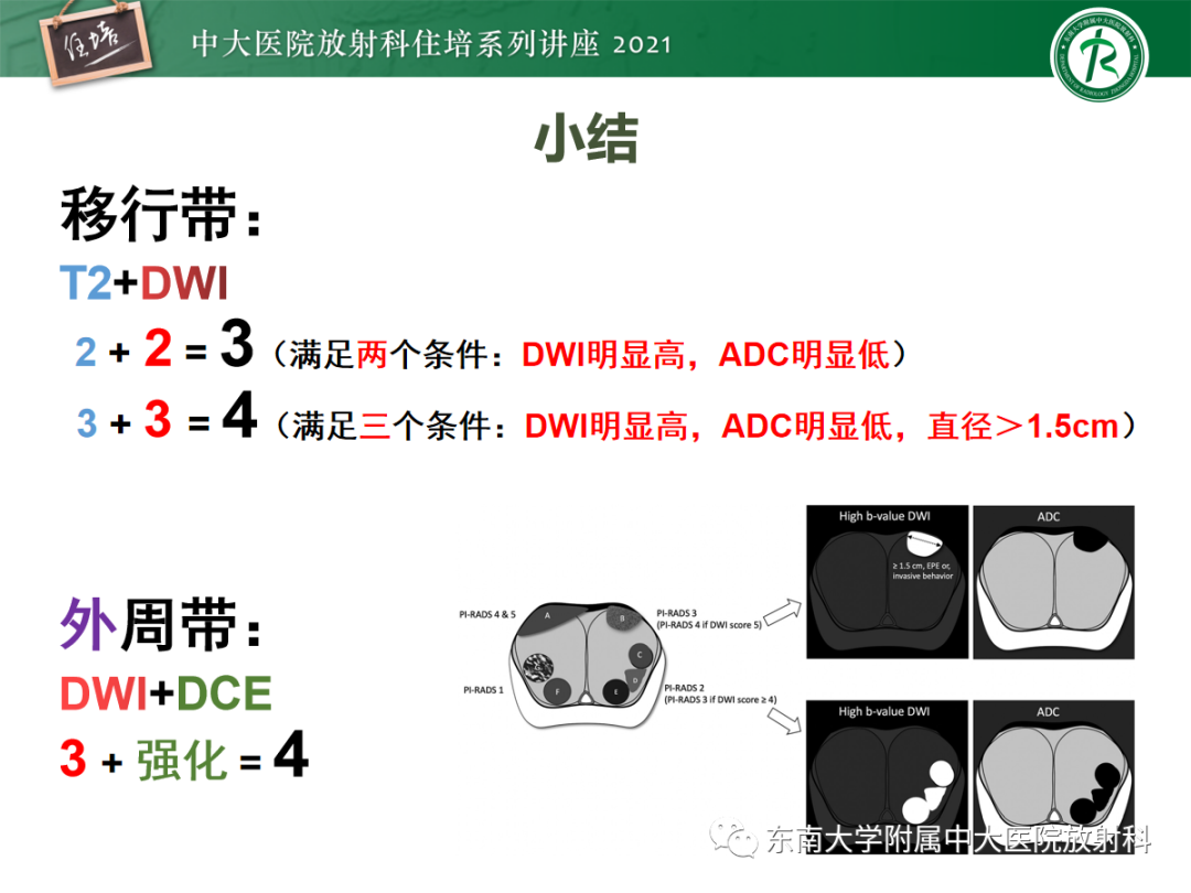 影像PPT - 【PPT】前列腺PI-RADS v2.1要点解读及临床应用-43