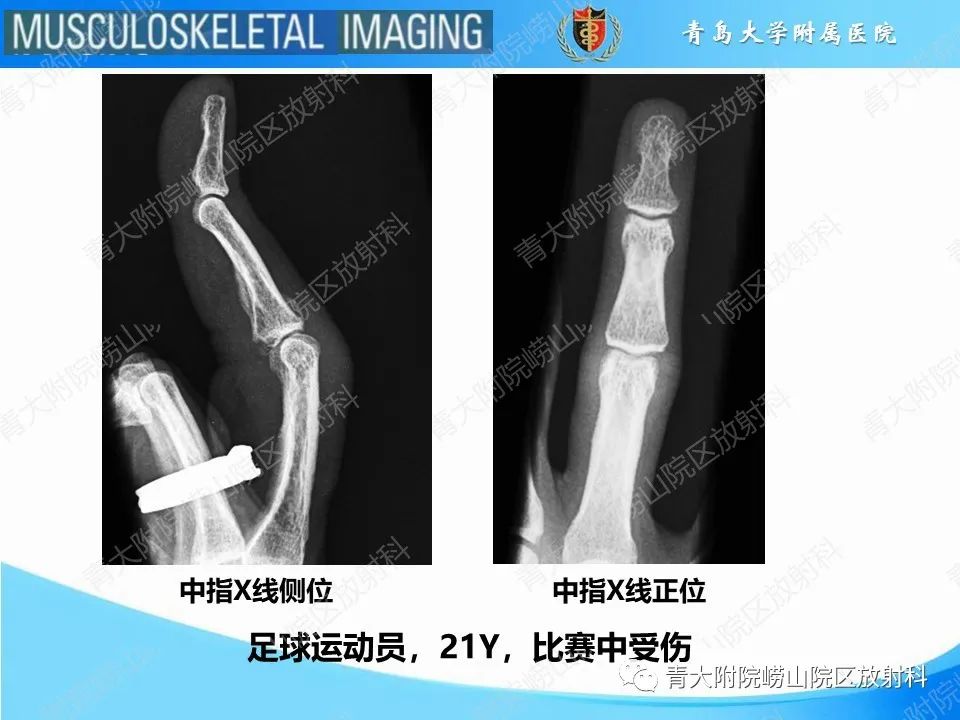 影像PPT - 【PPT】纽扣孔畸形-2