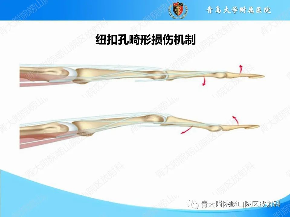 影像PPT - 【PPT】纽扣孔畸形-9